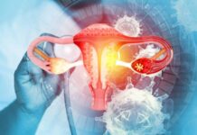 Cáncer de cuello uterino: Causas, prevención y factores de riesgo Cáncer de utero