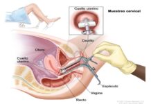 Detección del cáncer de cuello uterino cáncer de utero