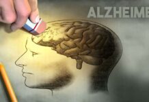 Alzheimer últimos avances en su tratamiento Alzheimer nuevos avances en su tratamiento